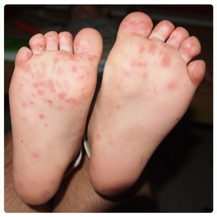 Hand Foot Mouth Disease-HFMD