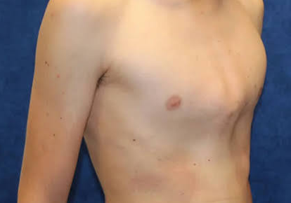 صدر الحمامة Pigeon chest
